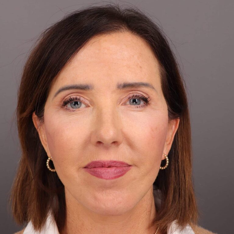 After Image: Facelift, Browlift, Upper & Lower Blepharoplasty, Chin Implant & Fat Graft - front