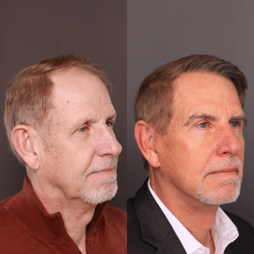 Facelift Before & After