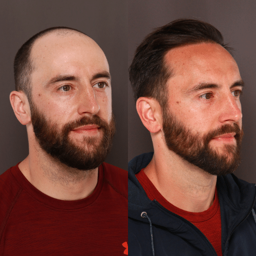 HAIR TRANSPLANT & Rhinoplasty Before & After