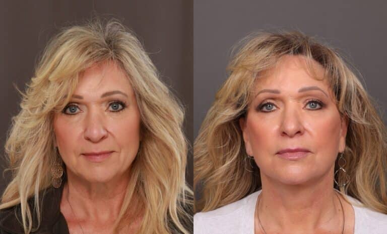 Before Image: Facelift with Dr. Thompson - front