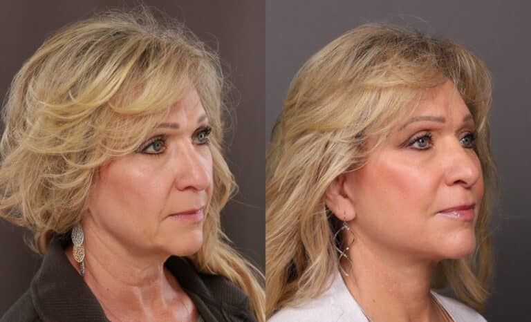 After Image: Facelift with Dr. Thompson - front