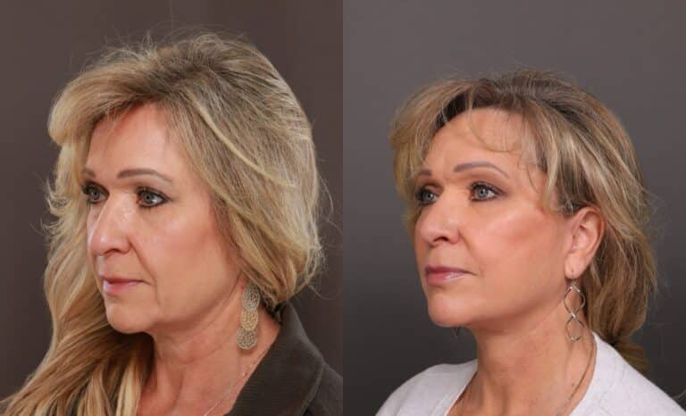 Before Image: Facelift with Dr. Thompson - front