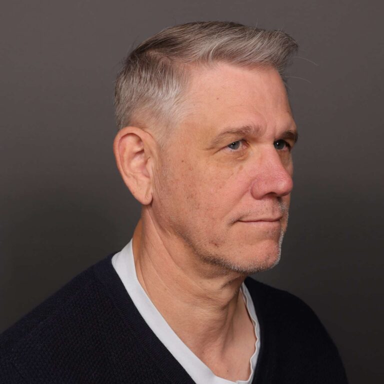 Before Image: Upper Blepharoplasty - front