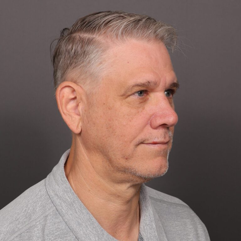 After Image: Upper Blepharoplasty - front