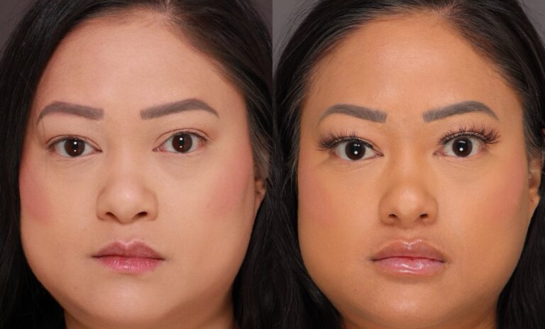 Before Image: Lip Filler with Sarah Olsen - front