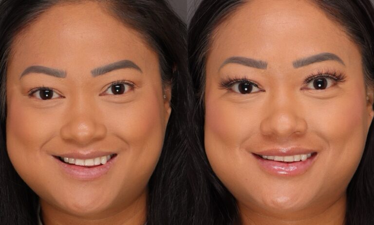 After Image: Lip Filler with Sarah Olsen - front