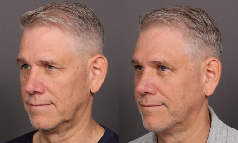 Before Image: Upper Blepharoplasty - front