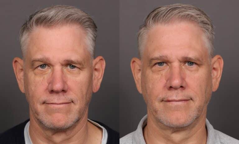 After Image: Upper Blepharoplasty - front