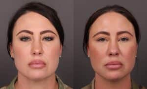 After Image: MACs Lift, Lower Blepharoplasty, Fat grafting, Buccal fat removal