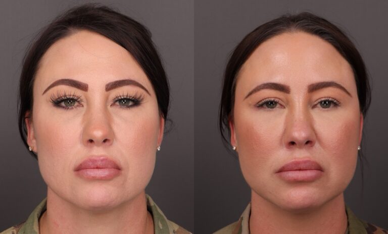 After Image: MACs Lift, Lower Blepharoplasty, Fat grafting, Buccal fat removal - front