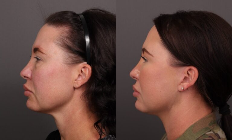 Before Image: MACs Lift, Lower Blepharoplasty, Fat grafting, Buccal fat removal - front