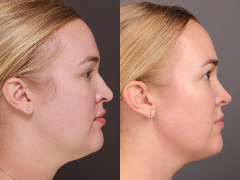 After Image: Rhinoplasty, Septoplasty - front