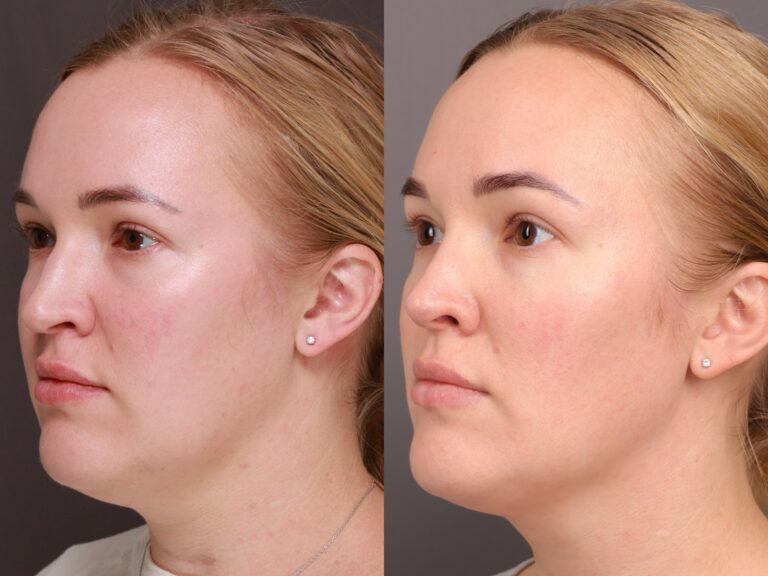 Before Image: Rhinoplasty, Septoplasty - front