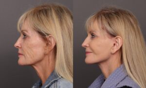 Before Image: Facelift & Brow Lift