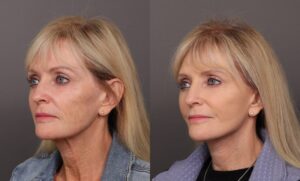 After Image: Facelift & Brow Lift