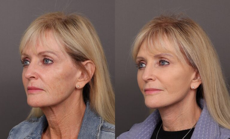 After Image: Facelift & Brow Lift - front