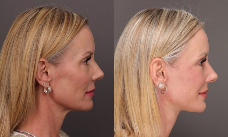 Before Image: Facelift with Lower Bleph and Fat Grafting & Contour TRL - 
