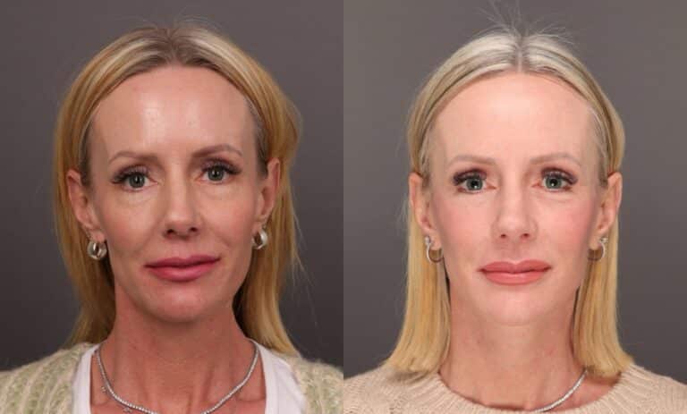Before Image: Facelift with Lower Bleph and Fat Grafting & Contour TRL - front