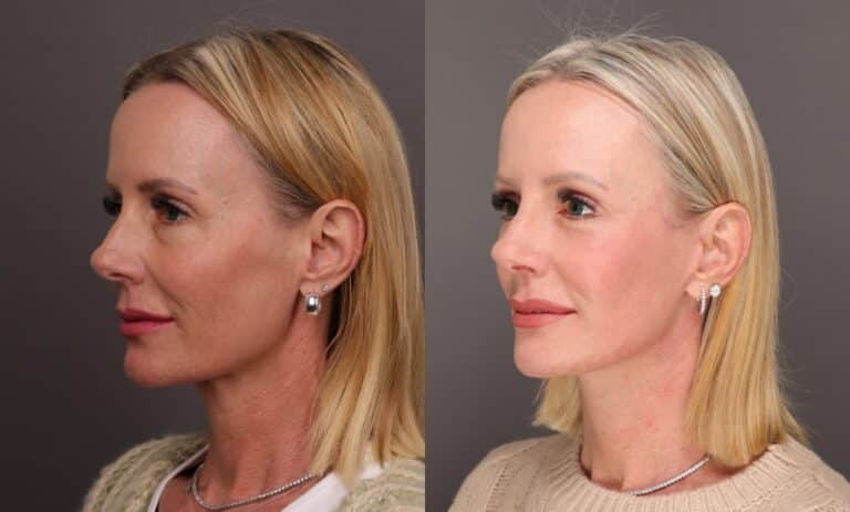After Image: Facelift with Lower Bleph and Fat Grafting & Contour TRL - front