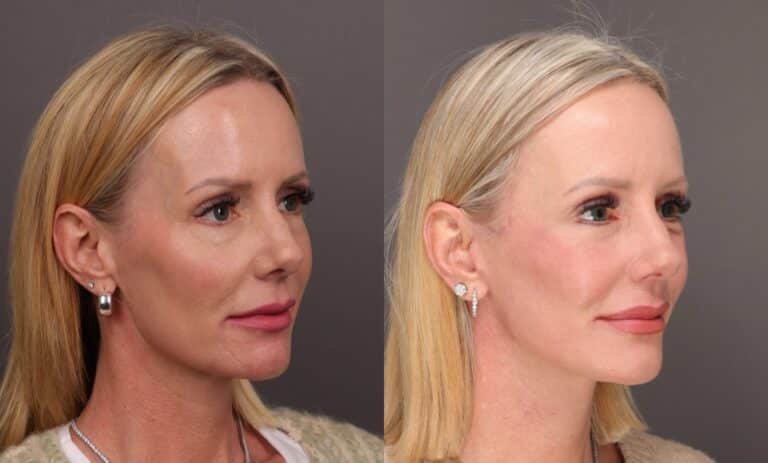After Image: Facelift with Lower Bleph and Fat Grafting & Contour TRL - 