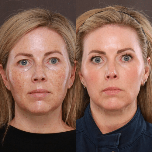 2 Moxi and BBL laser treatments