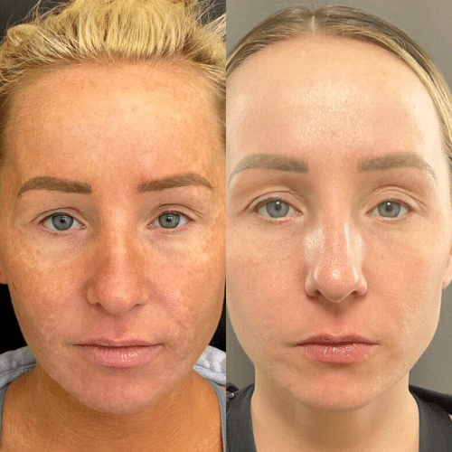 Collagen Induction Therapy, Moxi, & BBL