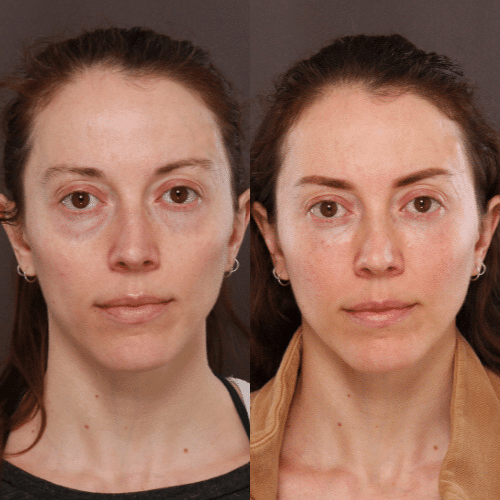 Facelift Before & After