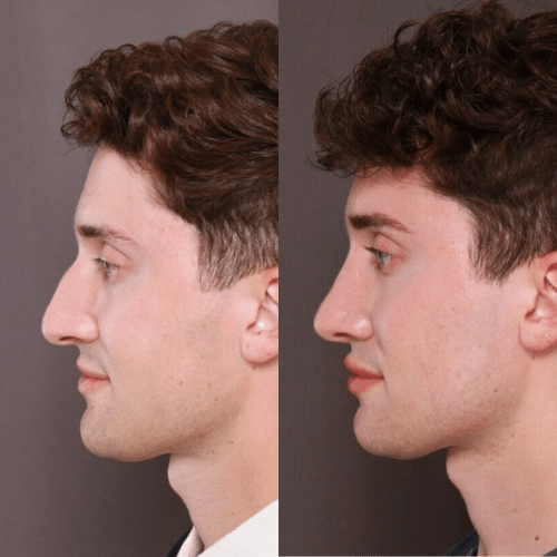 Facelift Before & After (2)