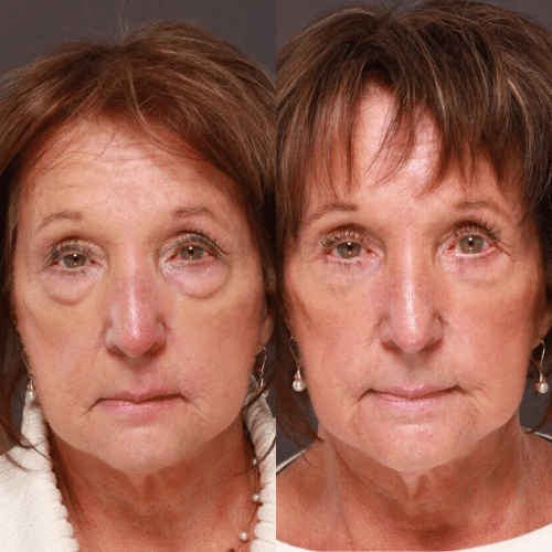 Facelift Before & After (3)