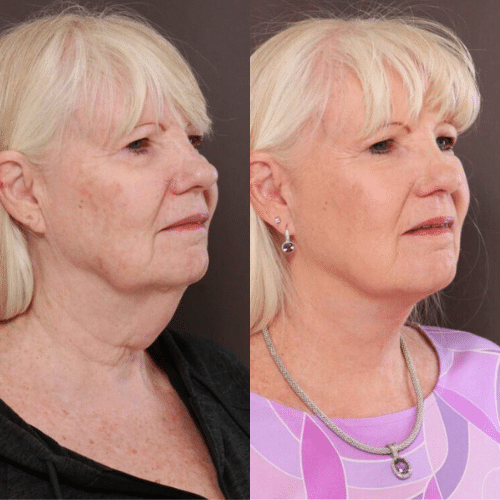 Facelift Before & After (4)