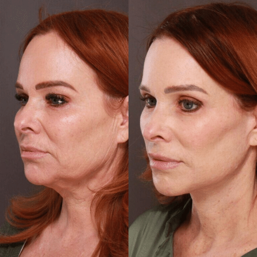 Facelift Before & After