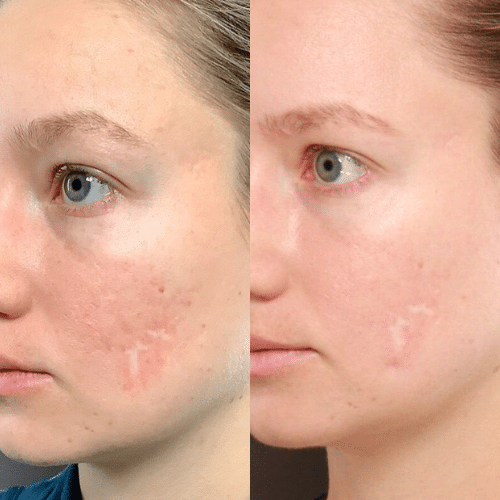 Halo & BBL Treatments