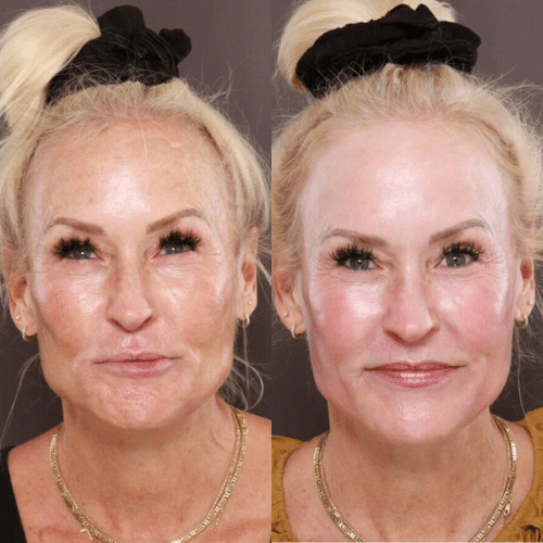 Halo Laser Treatment