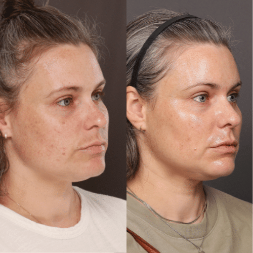 Moxi Laser Treatment