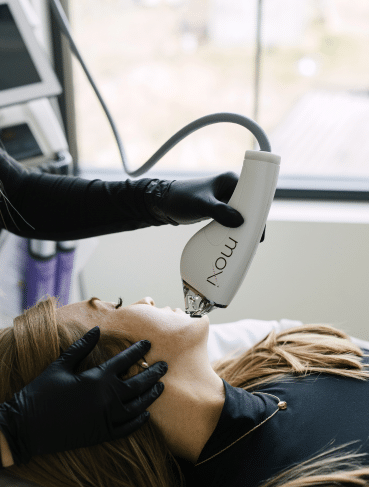 Moxi laser skin resurfacing