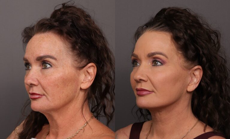 Before Image: Facelift, Skin Pinch & Contour TRL - front