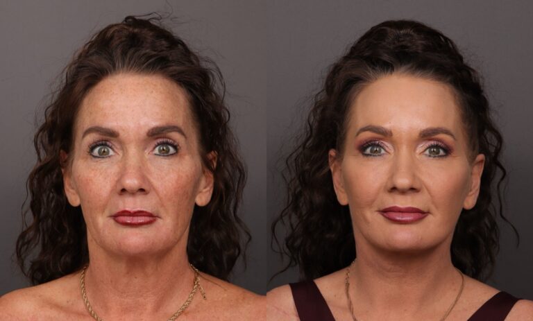 After Image: Facelift, Skin Pinch & Contour TRL - front