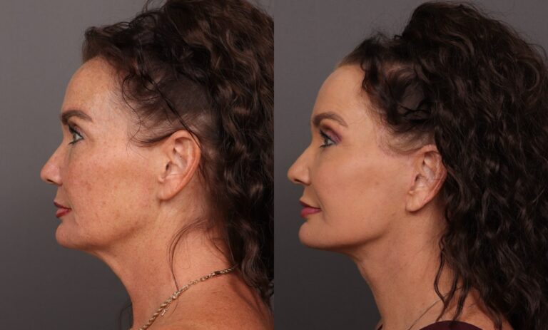 Before Image: Facelift, Skin Pinch & Contour TRL - front