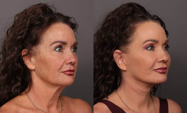 Before Image: Facelift, Skin Pinch & Contour TRL - front