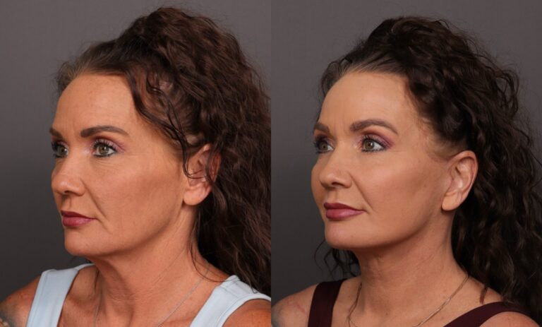 After Image: Facelift, Skin Pinch & Contour TRL - front