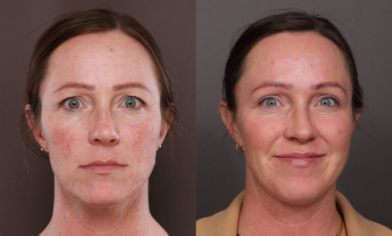 Before Image: BBL & Moxi and Lip Filler - 