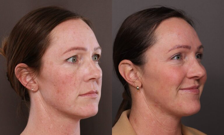 After Image: BBL & Moxi and Lip Filler - 