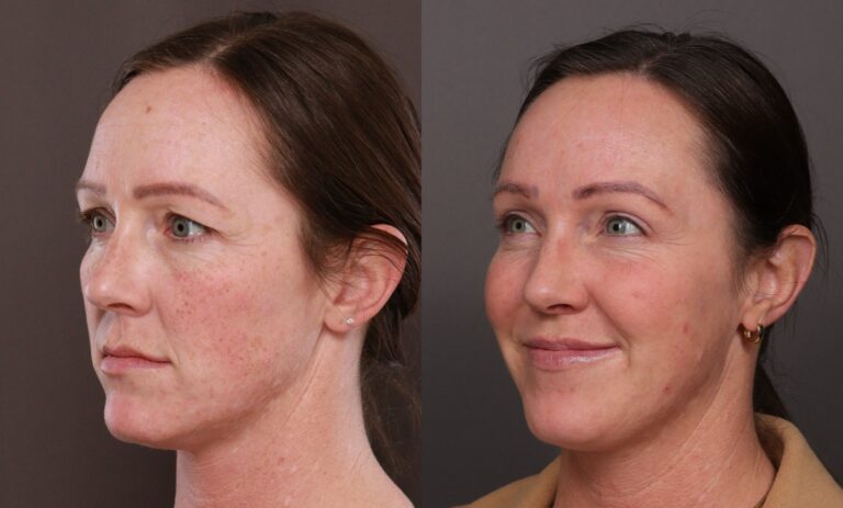 After Image: BBL & Moxi and Lip Filler - 