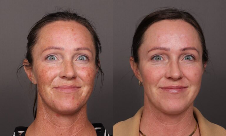 Before Image: BBL & Moxi and Lip Filler - front