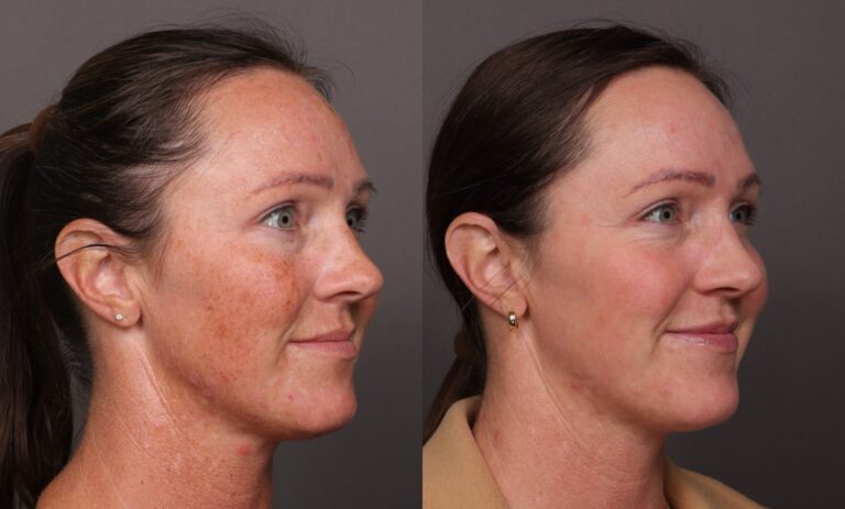 After Image: BBL & Moxi and Lip Filler - front