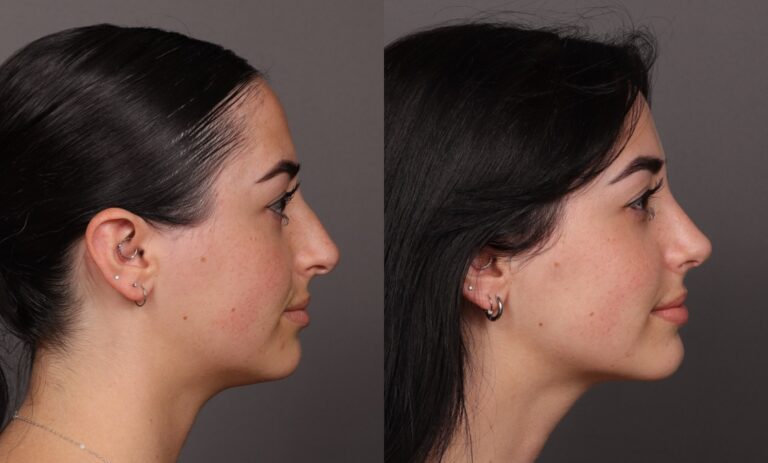 After Image: Rhinoplasty - front