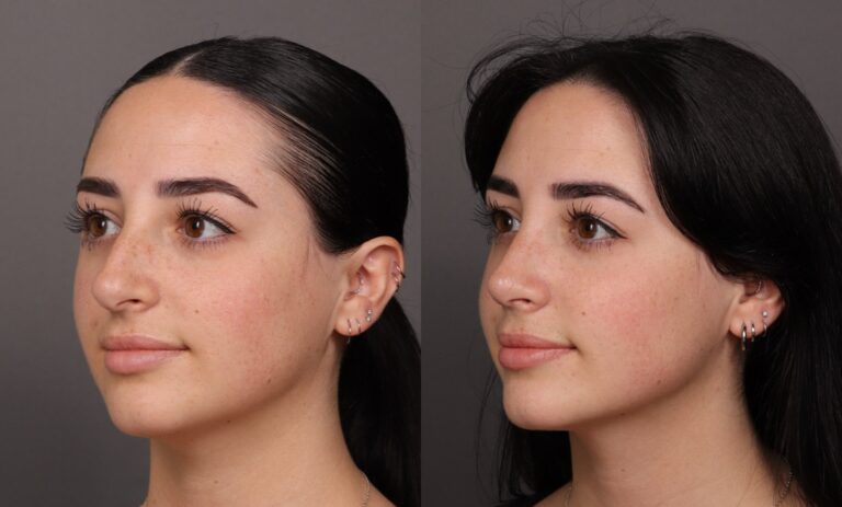 After Image: Rhinoplasty - front