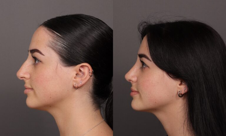 Before Image: Rhinoplasty - front