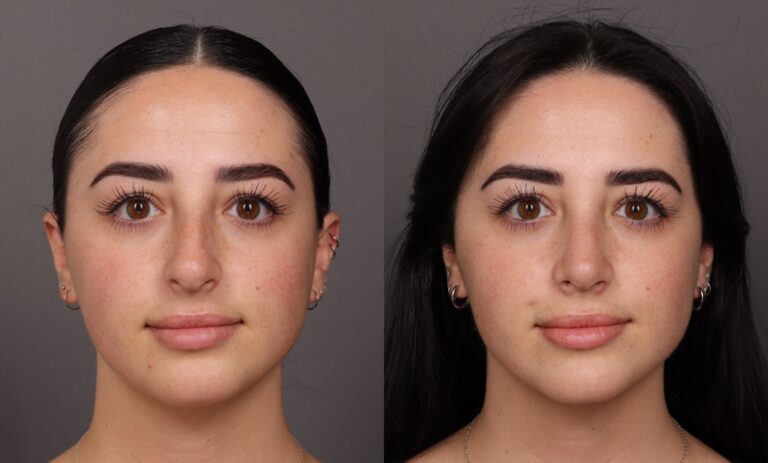 Before Image: Rhinoplasty - front