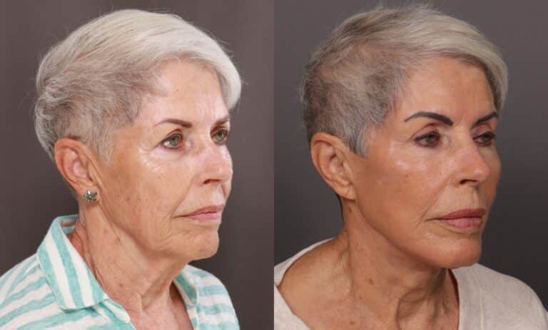 After Image: Facelift, Blepharoplasty, Fat Grafting, Contour TRL, Botox, Dermal Fillers, and Hydrafacial - front